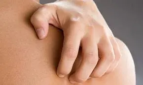 orticaria