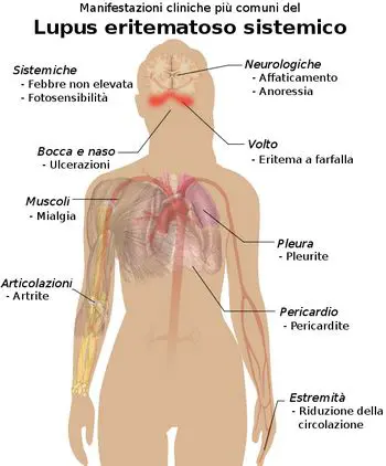 lupus_manifestazioni