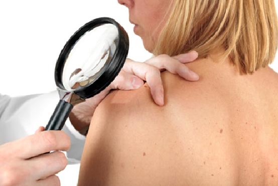 Melanoma: ogni anno colpisce 2.260 under 40. Serve più prevenzione!