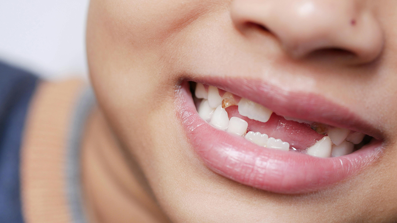 Igiene orale nei bambini: come e quando iniziare a lavare i denti ai più piccoli